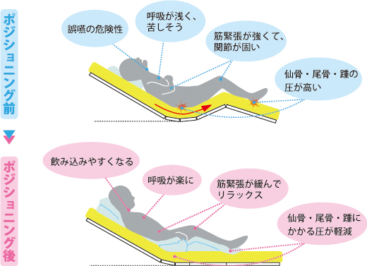 障害児のポジショニングの研修@北九州市立総合療育センター